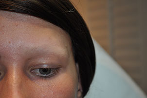 Alopecia Areata voor de behandeling