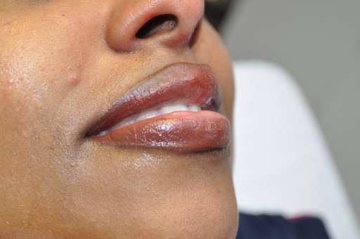 lips_behandeling_2